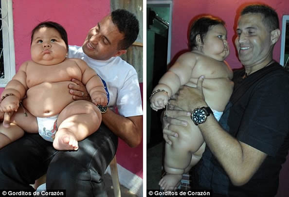 哥伦比亚8个月大男婴 已是约6岁孩子的体重