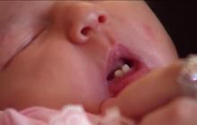 美一女婴出生就有两颗门牙  专家称“出生牙”