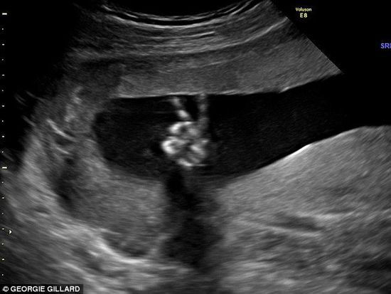 英国一胎儿在超声波图像中用小手比出“剪刀手”