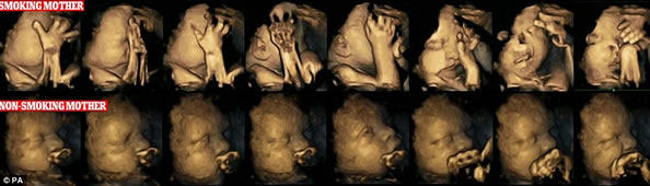 直观的视图告诉你 孕妇吸烟对胎儿的影响