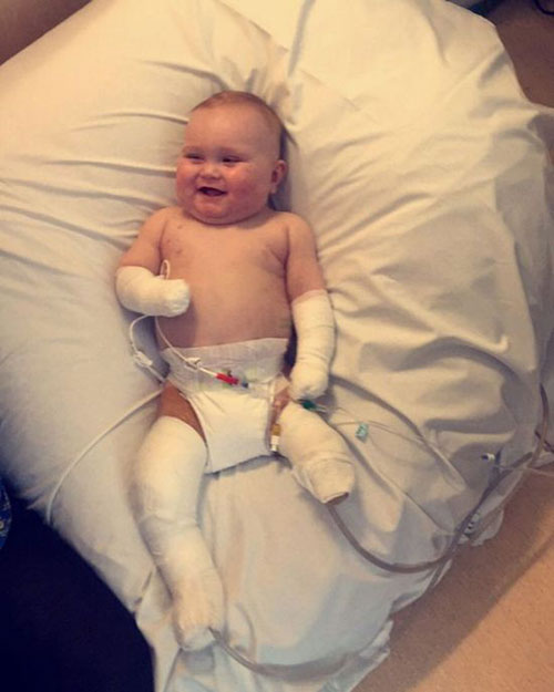 英国11个月大宝宝手术截肢后勇敢乐观面对 感动医生护士们