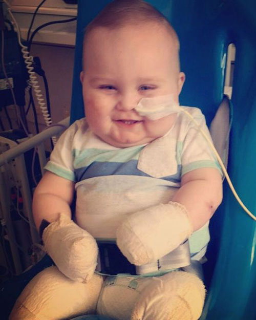英国11个月大宝宝手术截肢后勇敢乐观面对 感动医生护士们