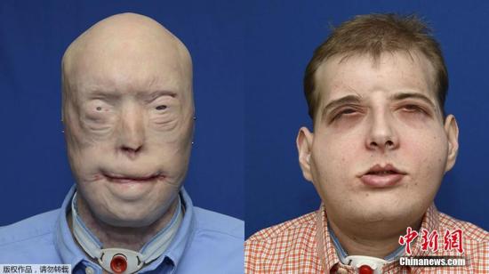 世界最高难度换脸手术：美国毁容男子拥有“全新的脸”