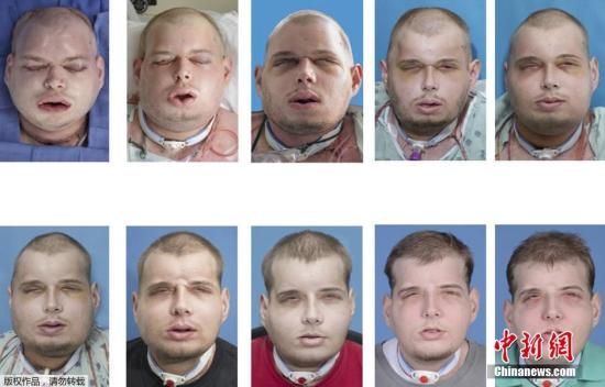 世界最高难度换脸手术：美国毁容男子拥有“全新的脸”