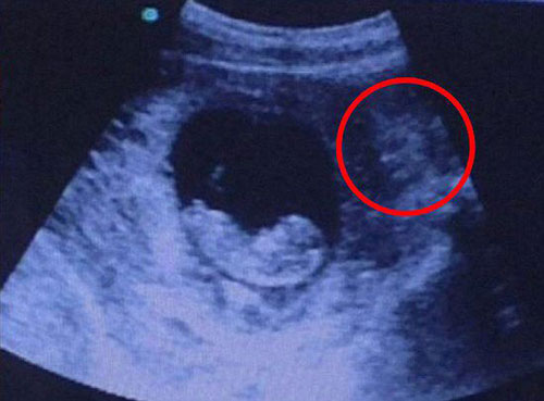 2月大胎儿超声波照片酷似被“恶魔”注视