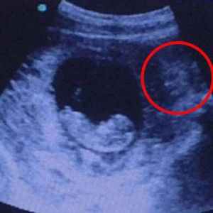 2月大胎儿超声波照片酷似被“恶魔”注视