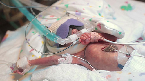 生命的奇迹：巴掌大的早产儿长成萌宝宝